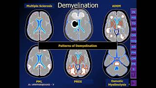 ⚕️ Making Sense of White Matter Disease by James G Smirniotopoulos MD [upl. by Anitsyrhk]