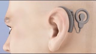 Cochlear Implant Animation [upl. by Aioj]