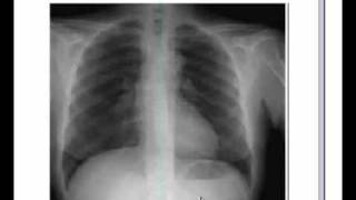 Respiratory system X ray Chest Pneumonia [upl. by Eixid]