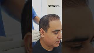 PRP treatment  Hair Loss Treatment  PRP for Hairloss  PRP Before amp After Result [upl. by Odlanyar613]