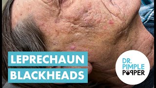 Blackhead Blackheads amp Blackheads Extended Leprechaun Blackheads [upl. by Okihcas]