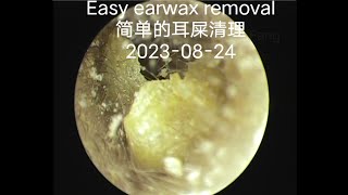 Easy earwax removal简单的耳屎清理20230824 [upl. by Refinej]