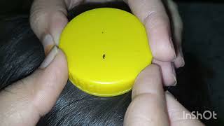 ASMR Nurse check lice picking asmr liceandnits licepicking asmrlicecheck [upl. by Eednak]