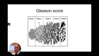 Prostate Cancer Grading and Staging [upl. by Anidene]