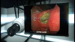 Gastric Ulcer [upl. by Ameehsat315]