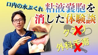 口腔内の水ぶくれ 粘液嚢胞 薬なし外科手術なし 粘液嚢胞を克服した体験談 [upl. by Notnad685]