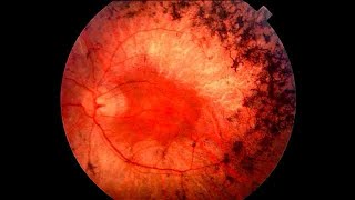 RETINITIS PIGMENTOSA LECTURE FULL EASY EXPLANATION DR SAIF ALI MEMON [upl. by Yarrum]