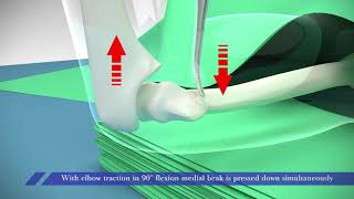 Supracondylar Fracture in ChildrenPercutaneous reduction technique [upl. by Tennaj]