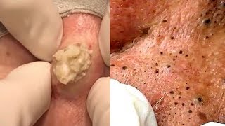 Cyst of the Year Greatest Blackheads amp Comedones [upl. by Arhaz]