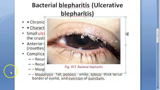 Ophthalmology 371 a Blepharitis Eye Lid Margin Inflammation Swelling Bacterial Ulcerative [upl. by Fara]