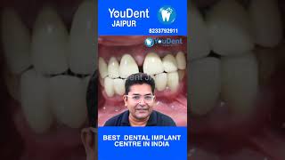 Full mouth dental implant Best dental implant centre in india YouDent Hospital Jaipur Dr rajesh [upl. by Zaller]