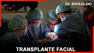 Primer trasplante facial del mundo de donante con paro cardiaco en el Hospital de Bellvitge [upl. by Halland]