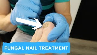 FUNGAL NAIL TREATMENT [upl. by Sergeant220]