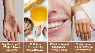 13 NATURAL Ways to GET RID of Warts and Moles FOREVER [upl. by Airod]