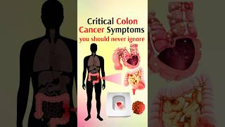 Critical colon cancer symptoms shorts [upl. by Angelia186]