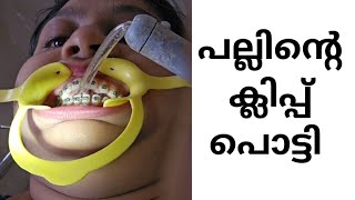 രണ്ടാഴ്ച്ച കൊണ്ട് ഞാൻ ക്ലിപ്പ് പൊട്ടിച്ചു  Braces pallinu kambiyittumalayalamvlog familyvlog [upl. by Noitna130]