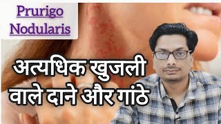 अत्यधिक खुजली वाले दाने और गांठे  हाथ और पैर पर खुजली  Prurigo Nodularis  Eczema  Itchy Rashes [upl. by Jun963]