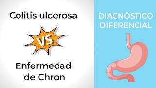 Diagnóstico Diferencial Colitis ulcerosa vs Crohn [upl. by Knoll909]