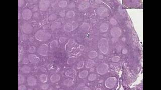 Histopathology Lymph node Follicular lymphoma grade 2 [upl. by Fritzsche]