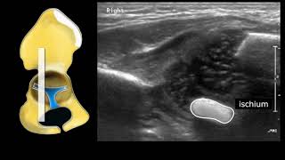 Congenital Hipdysplasia  Triradiate Cartilage [upl. by Lyell422]