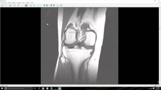 Medial Meniscus Tear MRI Posterior Horn [upl. by Gerstner]