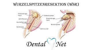 Wurzelspitzenresektion WSR ablauf [upl. by Eicak695]