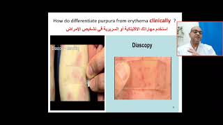 How to differentiate purpura from Erythema clinically is it Erythema or erythrocytes extravasation [upl. by Avi]