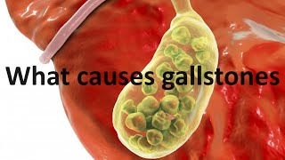 What causes gallstones and the thyroid hormone connection [upl. by Anaynek]