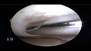 Chondroplasty and Drilling  Dr Steven Struhl [upl. by Arej967]