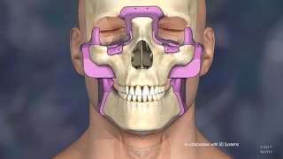 Mayo Clinic’s First Face Transplant The Surgery [upl. by Anilasor600]