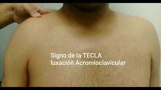 SIGNO DE LA TECLA LUXACIÓN ACROMIOCLAVICULAR [upl. by Barolet]