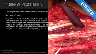 Flexor Digitorum Profundus Tenodesis Median FDP to Ulnar FDP  Extended Feat Dr Mackinnon [upl. by Austina]