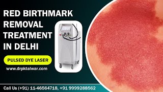 Red Birthmark Removal  Portwine Stain Removal in Delhi India by Pulsed Dye Laser  Dr PK Talwar [upl. by Ssegrub793]