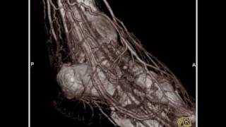 Vascular CT angiography of the lower extremity3 of 3 [upl. by Stilwell]