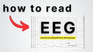 EEG Patterns IEDs  What do they mean [upl. by Tran]