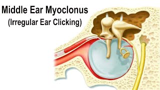 Middle Ear Myoclonus  Irregular Clicking Sound in the Ear [upl. by Euginom]