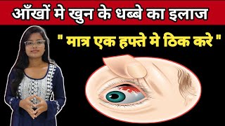 Sub Cunjuctiva Hemorrhage Treatment  Ankho Me khun ke Lal Dhabbe Ka Ilaz  In Hindi [upl. by Three]