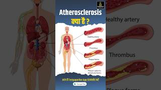 Atherosclerosis के क्या है  Causes sign and symptoms atherosclerosis testpaperlive shorts [upl. by Ainahtan667]