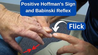 Positive Hoffmans Sign and Babinski Reflex in an MS Patient [upl. by Adnilram]