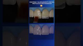 Diastema y Alargamiento Incisal carillasdirectas [upl. by Esilahc]