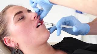 Skin  Surgery Clinics  Lippen opvullen met filler [upl. by Arty418]