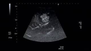 Imaging FNH with CEUS on Toshiba Aplio [upl. by Letha]