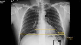 Como medir el ICT  Rx de tórax PA  Normal [upl. by Osmund]