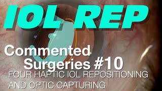 COMMENTED SURGERIES 10  Four haptic IOL Repositioning and Optic Capturing [upl. by Shepperd358]