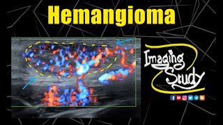 Superficial Hemangioma  Ultrasound  Doppler  Case 309 [upl. by Dieball]