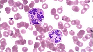 Haematology cases megaloblastic anemia [upl. by Tareyn267]