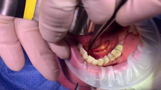 Transoral Sialolithectomy  Left Wharton´s duct [upl. by Anav]