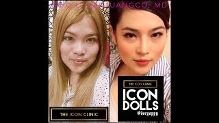 Nose Job  Asian Rhinoplasty RealPeople RealResults IconDolls IconWarriors TheIconClinic [upl. by Anohsal]