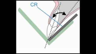 Bisecting Angle Technique TIPS [upl. by Esirahc]