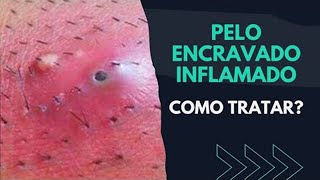 PELO ENCRAVADO INFLAMADO COMO TRATAR  SAIBA [upl. by Mayes656]